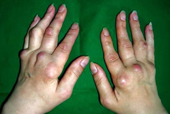 Ruce postižené polyosteoarthritis deformans