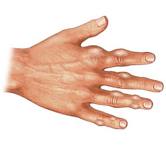 Usazování krystalů kyseliny močové v měkkých tkáních prstů s dnavou artritidou