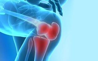jak se projevuje artróza kolenního kloubu