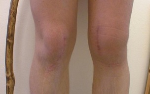stadia vývoje artrózy kolena