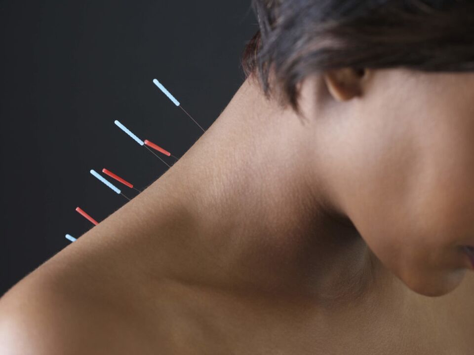 Akupunktura pro cervikální osteochondrózu odstraňuje zánětlivé procesy