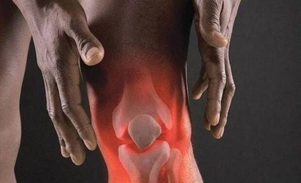 Artróza je doprovázena zánětlivým procesem v kolenním kloubu