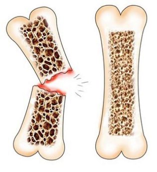  osteoporóza
